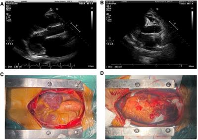 Donor/recipient ascending aortic diameter ratio as a novel potential metric for donor selection and improved clinical outcomes in heart transplantation: a propensity score-matched study